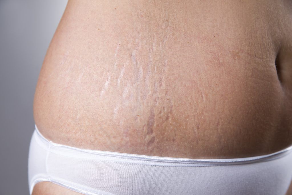 Photo of female belly with stretch marks