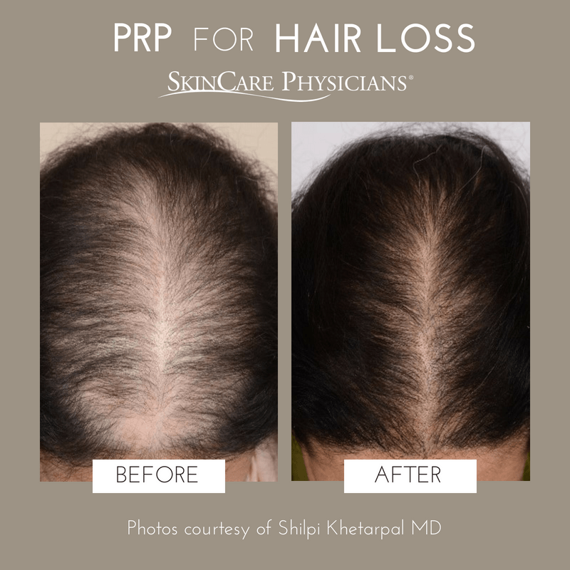 PRP Hair Restoration For Women - Philadelphia PA