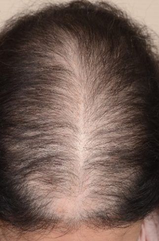 Platelet-Rich Plasma (PRP) for hair loss – Case 1 - SkinCare Physicians