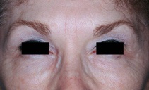 After treatment with botulinum toxin