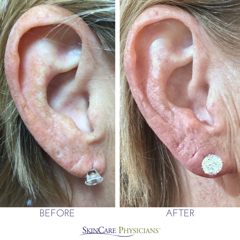 The Five-Minute Earlobe Fix - SkinCare Physicians