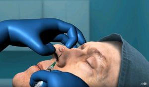Mohs surgery