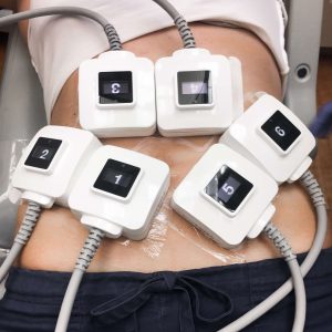 truSculpt iD probes on patient's abdomen