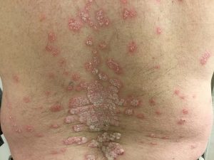 Plaque psoriasis on back of patient before Skyrizi treatment