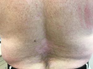 Plaque psoriasis on back of patient at 16 weeks of Skyrizi treatment