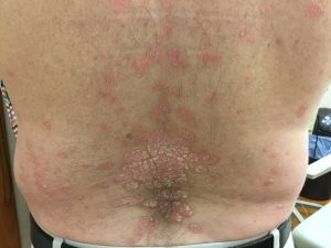 Plaque psoriasis on back of patient at 4 weeks of Skyrizi treatment