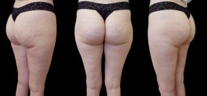 woman's buttock after Cellfina viewed from 3 angles