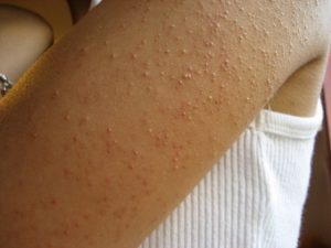 Keratosis pilaris (KP) on backs of arms of an adolescent