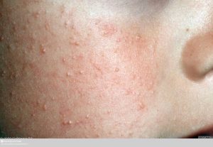 Keratosis pilaris (KP) on the cheeks of a child