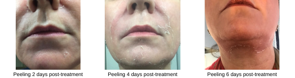 Peeling stages 2, 4 and 6 days post deep Vitalize peel