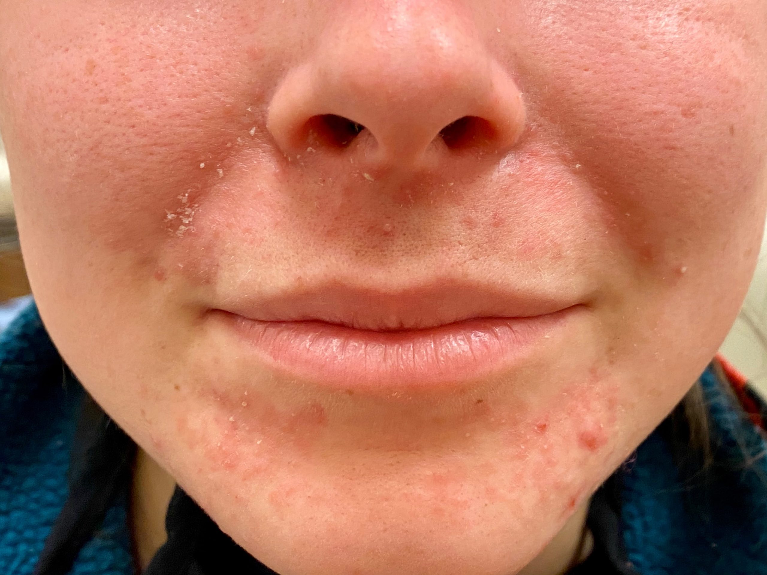 Acne Around Nose