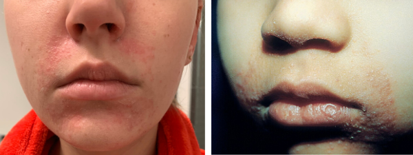 Examples of perioral dermatitis around the mouth of teenager and a child