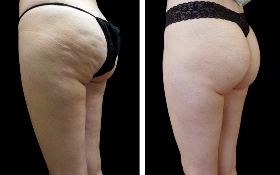 Before and after photos of Cellfina cellulite treatment