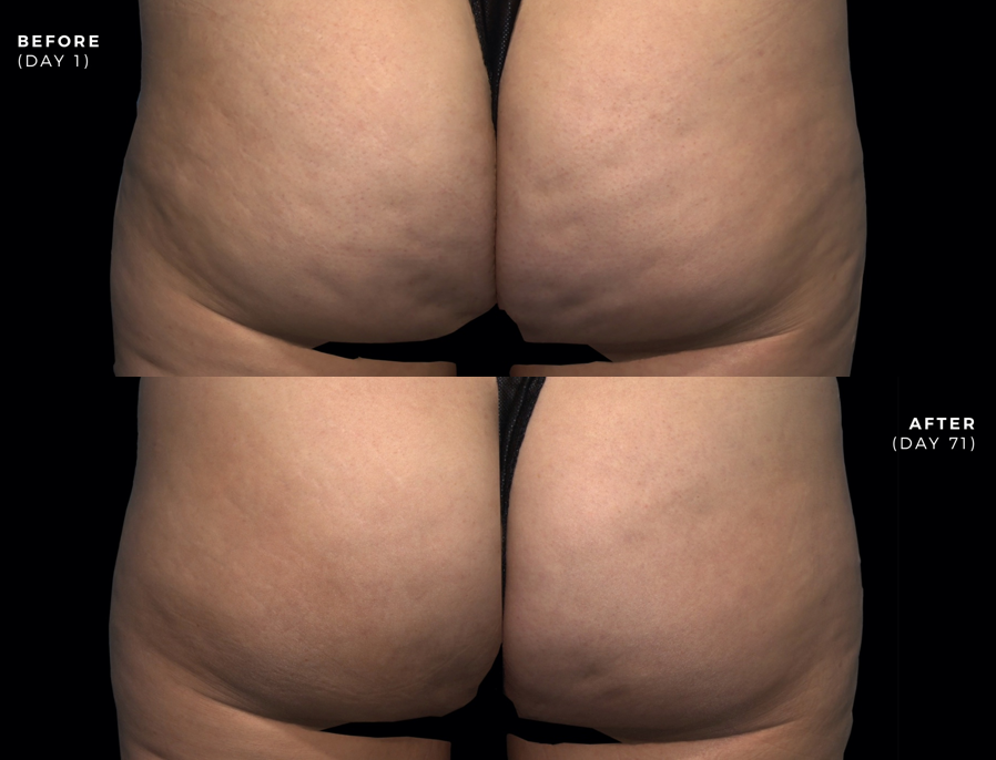 Before and after photos of Qwo cellulite treatment