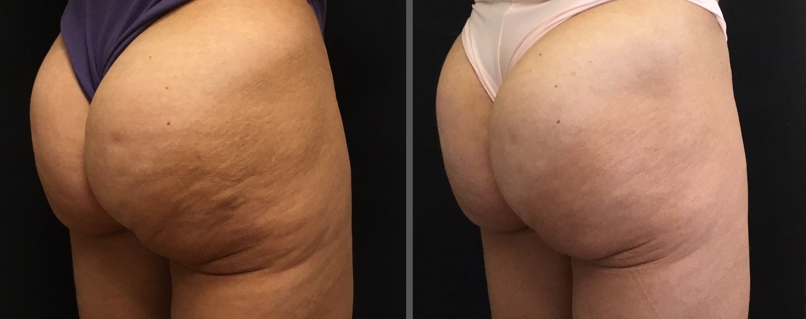 Before and after cellulite treatment with Sculptra filler