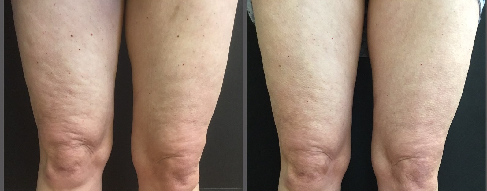 Cellulite Treatment Chevy Chase  Cellulite Reduction DC  Capital Laser   Skin Care