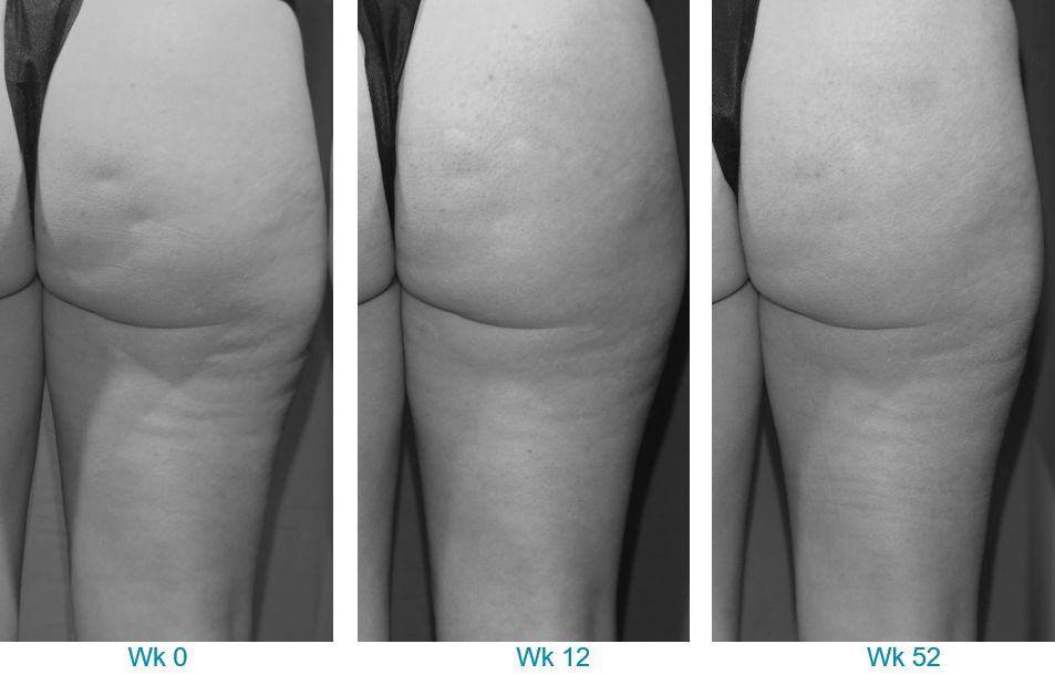 Before and after Resonic (Soliton) cellulite treatment