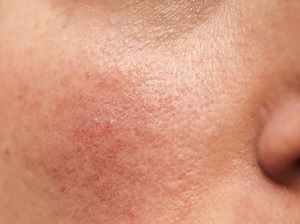 Rosacea on cheek