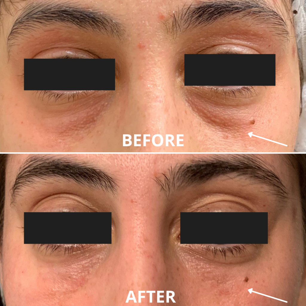 Before and after photos of the under-eye hollow treated with filler