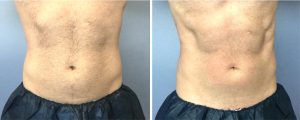 Before and after photos of a man's abdominal muscles stimulated with new device