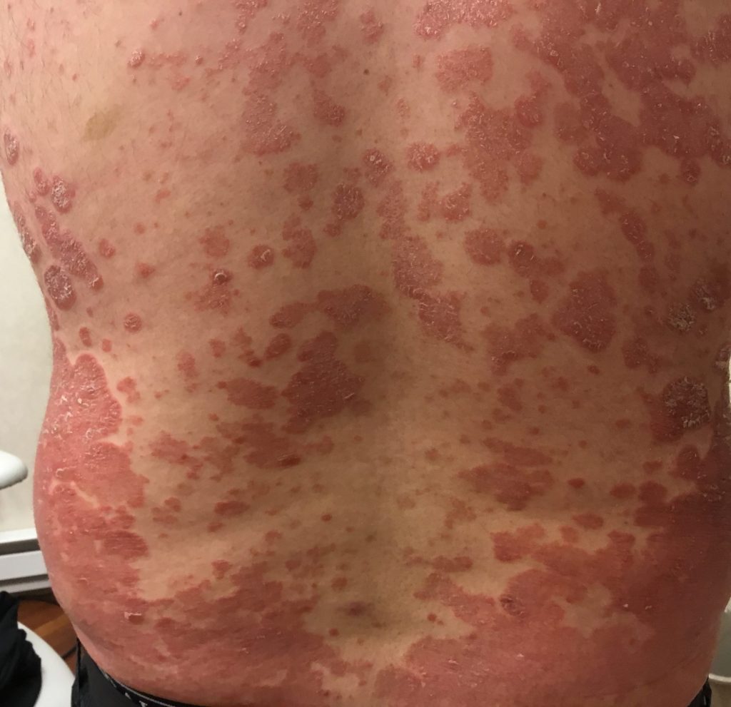 Patient suffering from psoriasis on his back