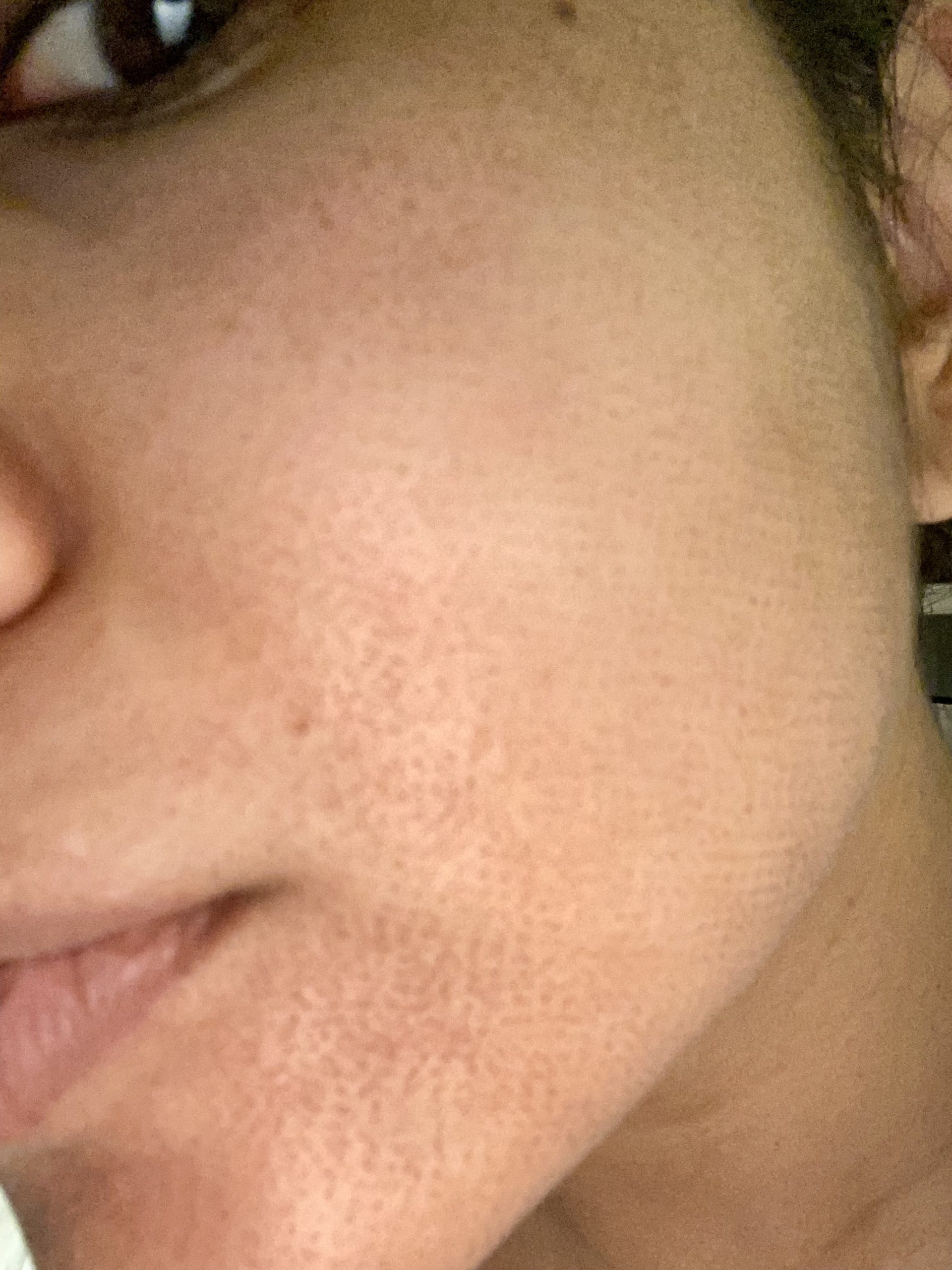 De minuscules points bruns sur le visage du Dr Christman après le traitement Fraxel 
