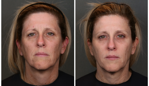 Patient before and after being treated by the Allergan Harmony study