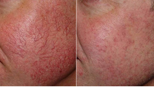 Photos of broken blood vessels on the cheeks, before and after IPL treatments