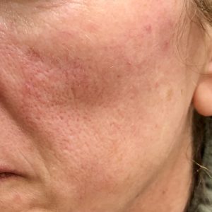 Woman's red cheek