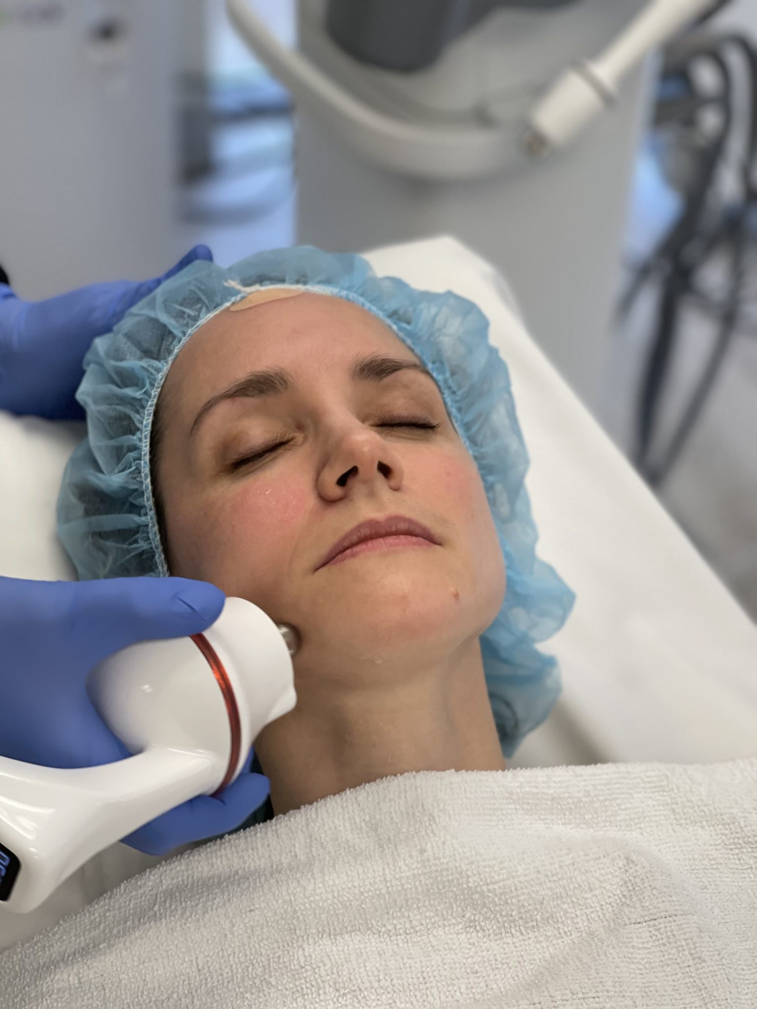Thinking about neck tightening? RF Microneedling may be right for you