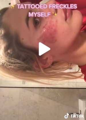 Young girl sharing on TikTok the disastrous results of tattooing freckles herself on her face