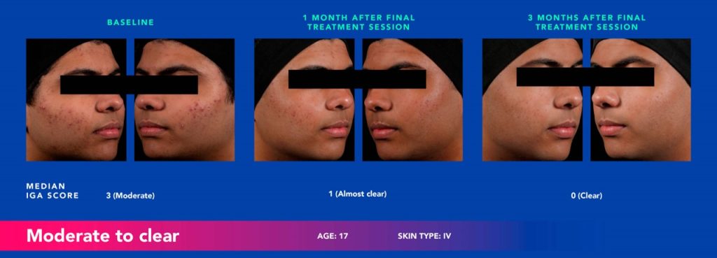 Before and after photos of a teenager's acne treated with AviClear.