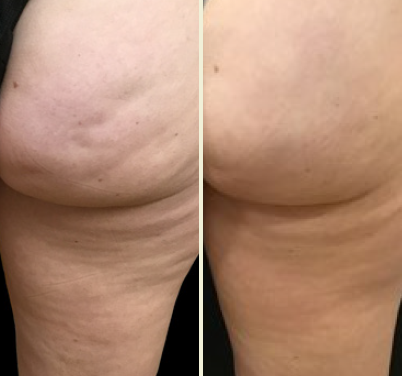 Before and after Aveli cellulite treatment on buttocks