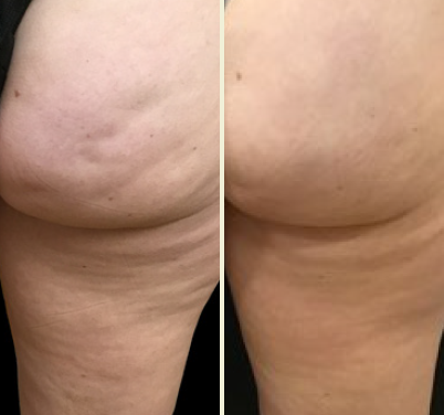 Comprehensive Guide To Avéli™ Long-Term Cellulite Treatment - Premier  Surgical Plastic Surgery