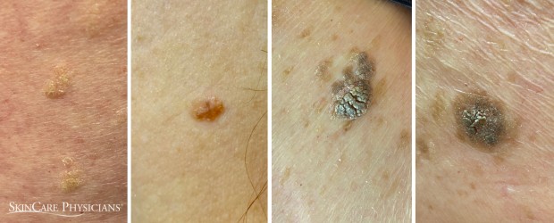 These four different seborrheic keratoses-SKs