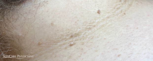 Skin tags on woman's neck