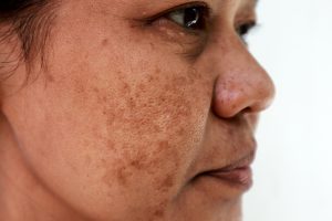 Melasma on an Asian woman's cheek