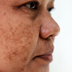 Melasma on an Asian woman's cheek
