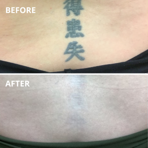 Tattoo removal - Before and after treatments