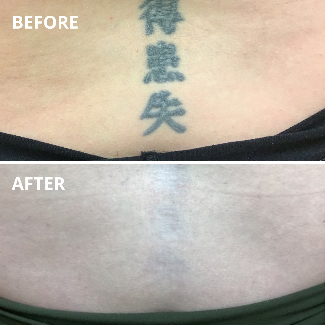 Tattoo Removal Options, Including the Safest One Available - Austin Tattoo  Removal - Clean Slate Ink