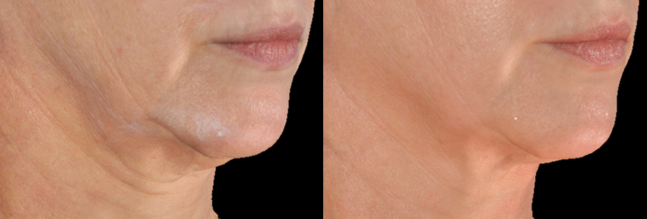Before & after photos of a woman's neck treated with the Genius microneedling device