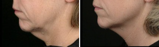 Before & after photos of woman's full neck tightened using Thermage