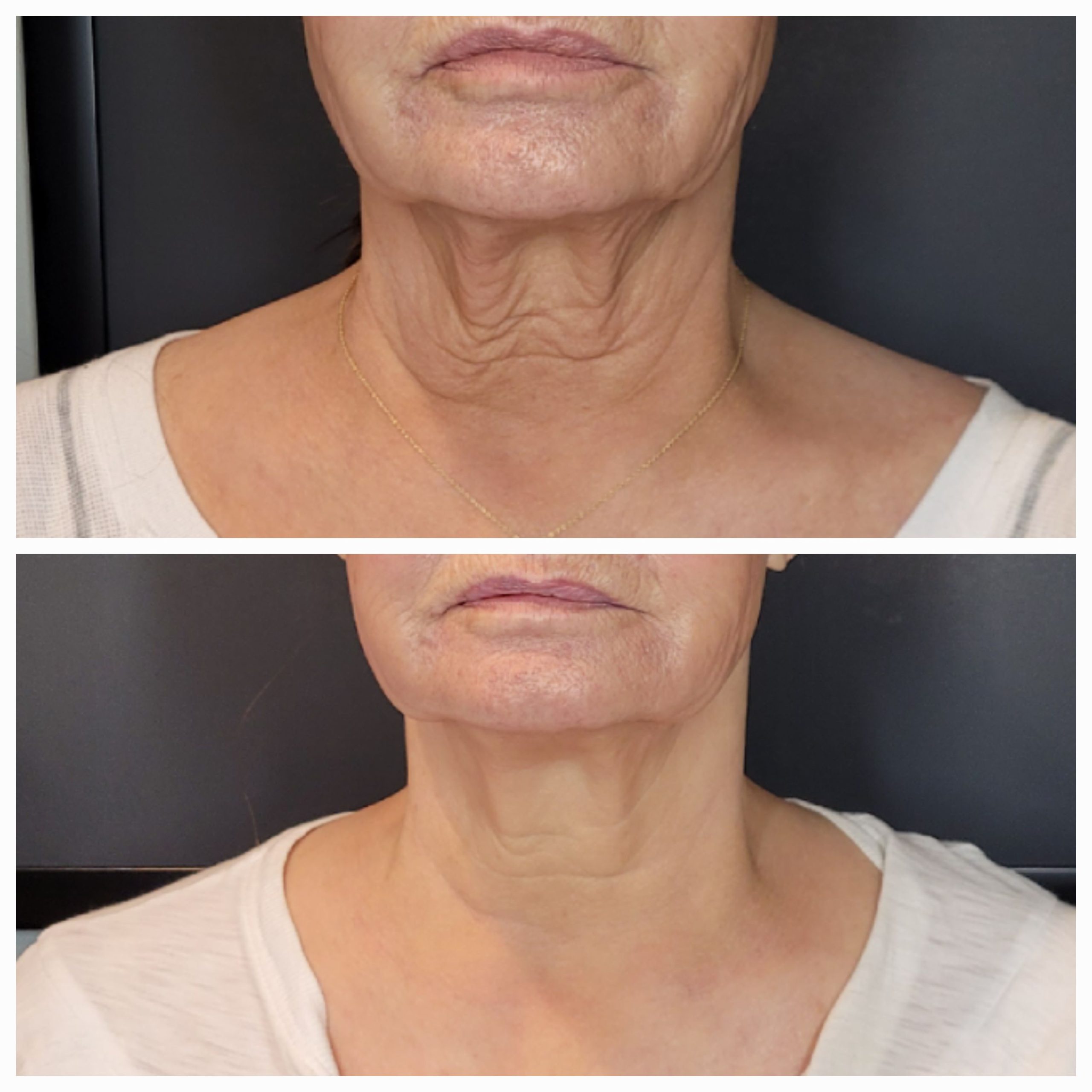 Before & after photos of woman's neck treated with Sofwave