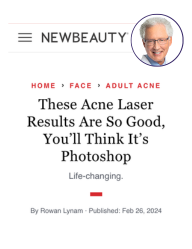 NewBeauty article quoting Dr. Dover on Aviclear