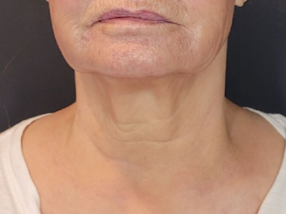 Neck after Sofwave treatment