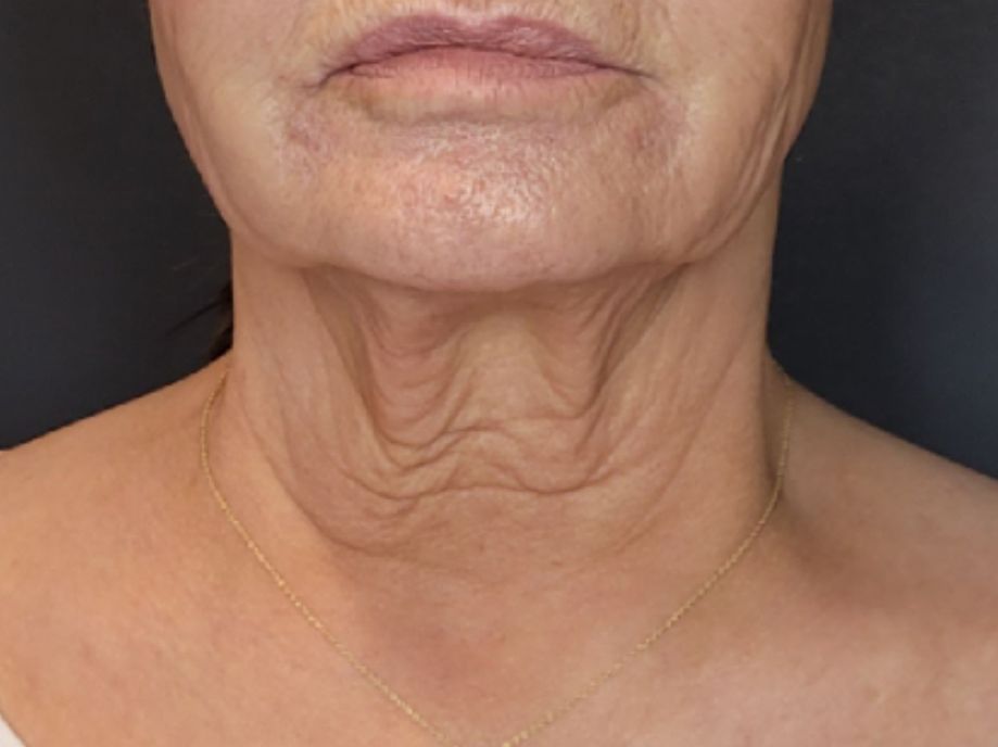 Neck before Sofwave treatment