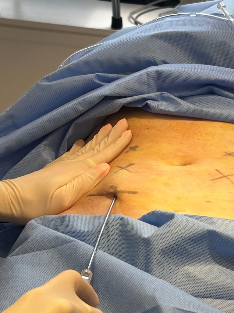 Dr. Labadie performing liposuction at SkinCare Physicians