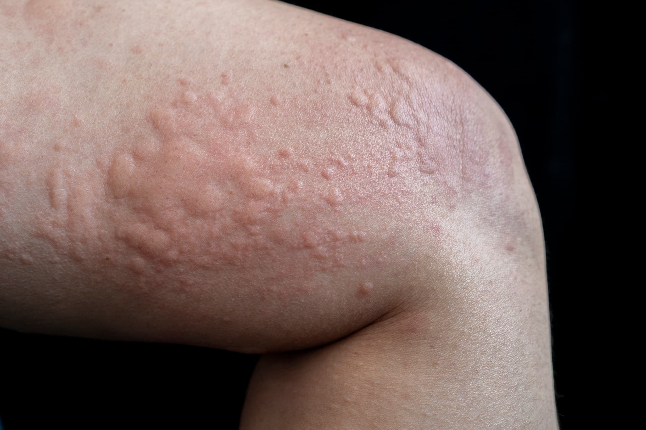 Chronic hives diagnosed on patient's thigh and knee