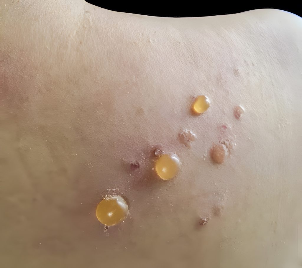 Closeup of blisters from bullous pemphigoid, a rare skin condition