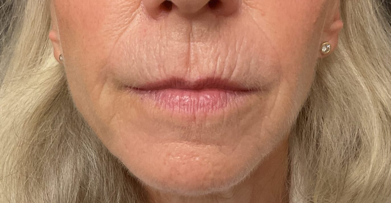 Close-up of woman's wrinkles and lines around mouse showing improvement after Tixel